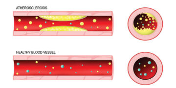 Managing Abnormal Cholesterol Levels