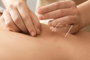 Acupuncture